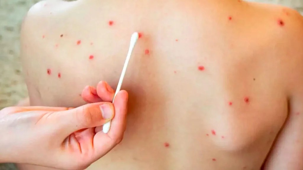 Zacatecas, tercer lugar en casos de sarampión.